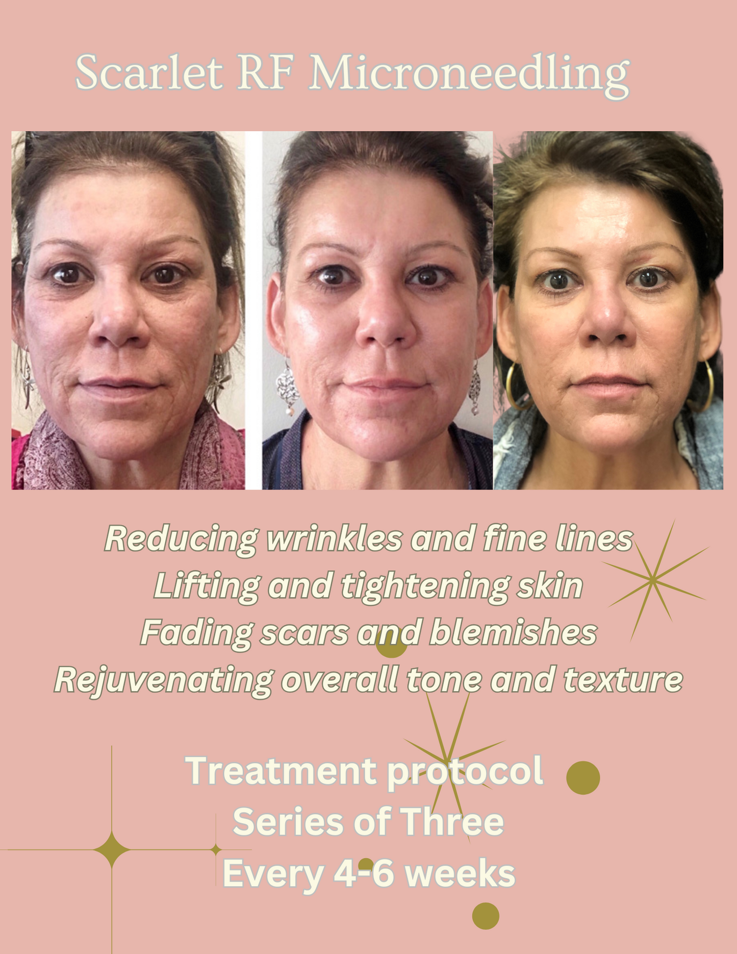 Skindale Skin Tightening (Scarlet RF)